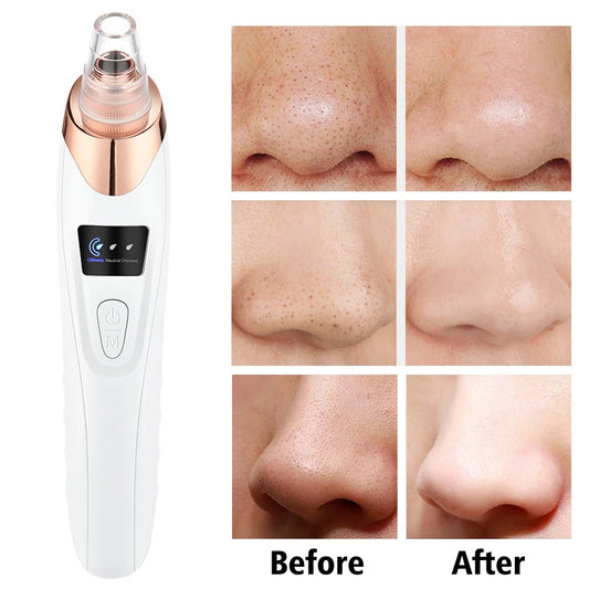 Blackhead Remover Electric Pore Nose Sucker Pimple Skin Acne Face cleanerVacuum